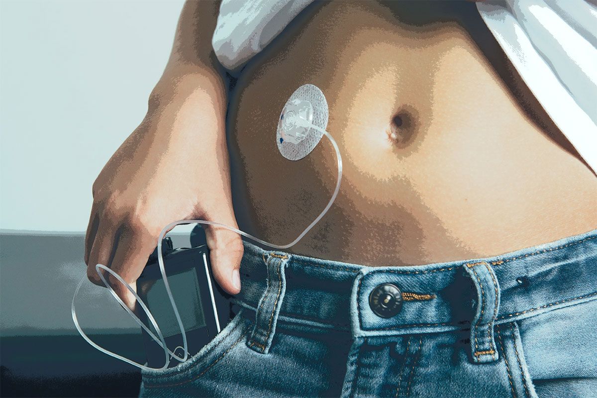 Close-up of a person’s abdomen with an insulin pump inserted into the skin and the device resting in the pocket of their jeans.