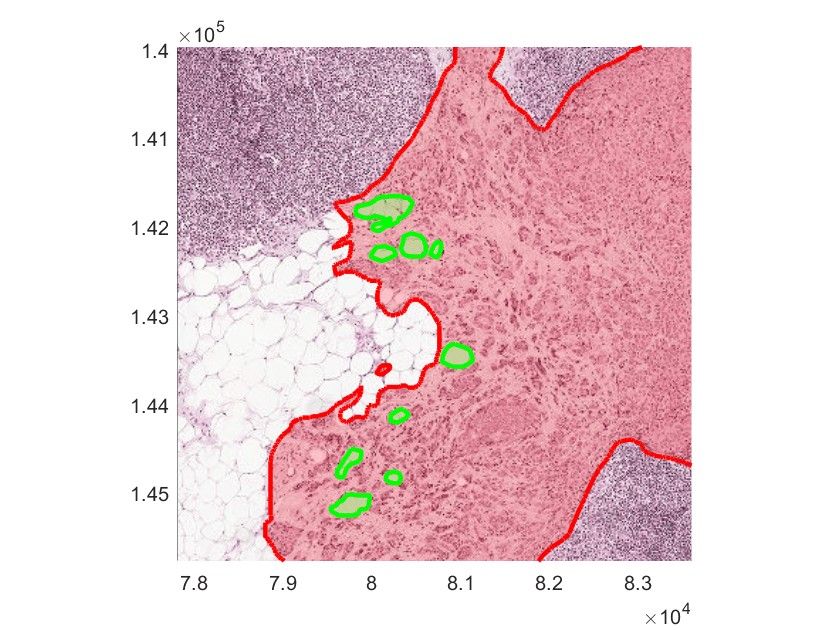 Medical image segmentation for tumor tissue with areas showing normal and tumor tissue.