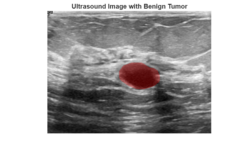 Classify Breast Tumors from Ultrasound Images Using Fuzzy Inference System