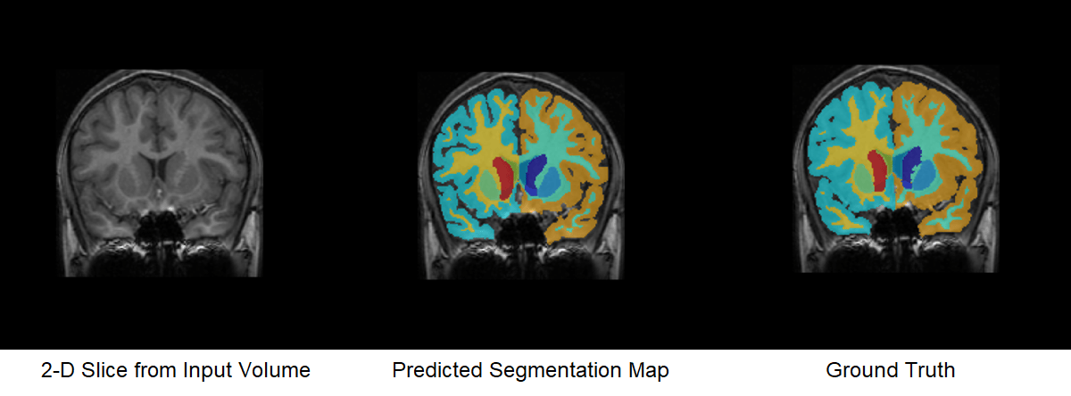 BrainMRISegmentationUsingTrained3DUNetExample_01.png